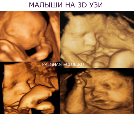 3D узи плода на 29 неделе беременности